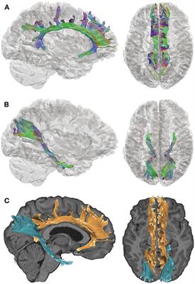 A Preliminary DTI Tractography Study of Developmental Neuroplasticity 5–15 Years After Early Childhood Traumatic Brain Injury